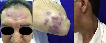 Image result for Tertiary Syphilis