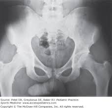 Image result for Pubic Apophysitis
