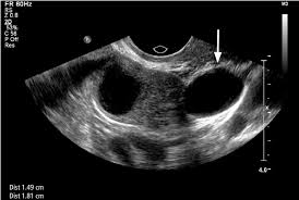 Ultrasound Video Showing Ovarian Pregnancy And Free Fluid In Cul De Sac. -  Youtube
