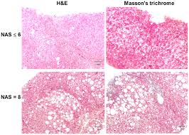 Plos One Anti Inflammatory And Anti Fibrotic Profile Of Fish Oil Emulsions Used In Parenteral Nutrition Associated Liver Disease