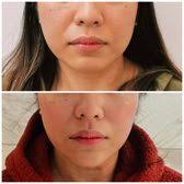 TOP 10 BEST Mole Removal in Las Vegas, NV