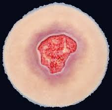 Stage 3 Pressure Injury – Techline Trauma