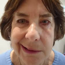 The affected muscles usually regain their original function within one to two months. Botox For Bell S Palsy Melior Clinics