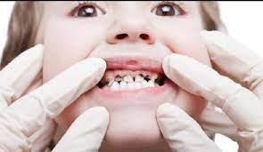 Kebiasaan anak minum susu menjelang tidur dapat menimbulkan plak yang menyebabkan karies gigi. Anak Sering Ngedot Ternyata Bikin Karies Gigi Makanya Setop Sekarang