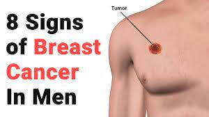 What does a cancerous breast lump feel like? 8 Signs Of Breast Cancer In Men