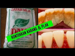 Melansir health line, cara terbaik untuk menghilangkan karang gigi atau kalkulus tidak lain adalah meminta bantuan dokter. Cara Menghilangkan Karang Gigi Dengan Garam Dapur Desainrumahid Com
