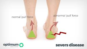 Image result for Calcaneal Apophysitis