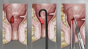 Image result for Hemorrhoid