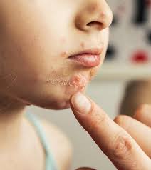 This image shows how hand, foot, and mouth disease presents on the hands. Hand Foot And Mouth Disease In Children Causes Symptoms And Home Care