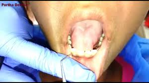 Fillings don't take long and are not that expensive, especially if you have dental insurance. How Long Does It Take To Fill A Tooth Cavities At The Dentist Ii Partha Dental Ii Youtube