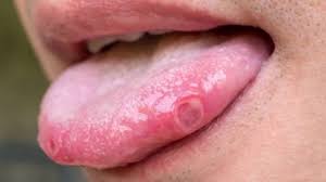 Image result for Puchýře na jazyku