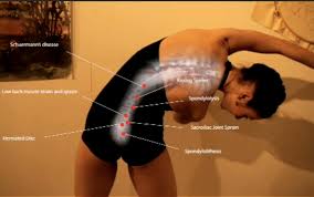 Image result for Dancer Injuries