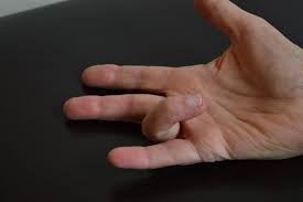 Trigger Finger - Susan Quin Physiotherapy