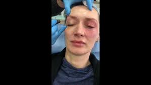 علاج و شد الجفون غير الجراحي بإستخدام تقنية #البلازماج #plasmage ...  النتائج و التحسن دائم و ليس مؤقت بإجراء بسيط يتم خلال دقائق في العيادة ...  الان ولفترة محدودة خصم 40% للإستفسار