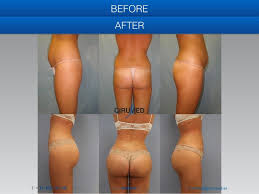 The fat that survives is permanent just like the existing fatty tissues in your buttocks. Pin On Fat Transfer