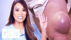 At the age of 39, she started uploading the videos on her youtube channel. Dr Sandra Lee Faces Her Biggest Cyst Yet Dr Pimple Popper Youtube