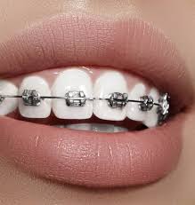 If you are required to come back for further treatment or you decide to seek private dental treatment, this does not mean that the rpo consultation is free. Custom Designed Braces Dental Care Family Dentist Pakuranga East Auckland