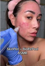 skinpen #skinpenmicroneedling #aesthetics #glasgowtiktok #glasgow #sk...