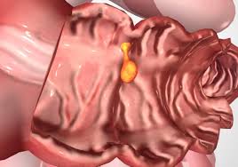I think i was 18 when i started noticing, ok i have a sensitive when they go in they could find lots of tumors or a colon that's obviously sick and that looks unhealthy, so he said everything looks really healthy which is great we. Colon Polyps Causes Symptoms And Treatment