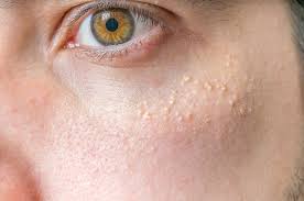 Apakah uv membuat kulit wajah jadi putih. 4 Penyebab Bintik Putih Atau White Spots Di Wajah