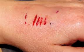 You've probably heard of the classic bullseye rash, which is one of the most distinct symptoms of lyme disease. Dog Bite Puncture Wounds Care Signs Of Infection Study Com