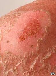 When detected early, bcc is typically successfully treated without complications or causing major harm to the patient. Skin Cancer Rise Due To Explosion In Holidays And Sunbeds In 1970s Bbc News