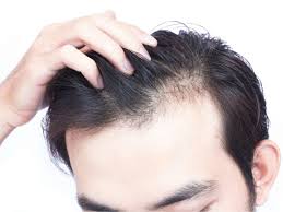 You might also be particularly unlucky and start off with relatively thin hair, leading to a higher chance of a receding hairline even before you enter. How To Regrow Hair Naturally