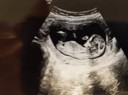Your midwife or doctor will give during an information leaflet that will tell you what you need to do. Flat Face On Ultrasound September 2019 Babies Forums What To Expect