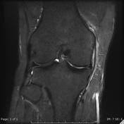Medial collateral ligament (mcl) injuries. Medial Collateral Ligament Injury Grading Radiology Reference Article Radiopaedia Org