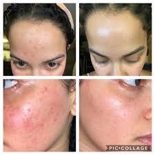Image result for demodex rosacea