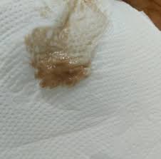 Sangrado De Implantacion Retraso Ayuda Porfavor Buscando Bebe Babycenter