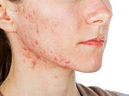 Genetics plays a large part as well. Jawline Acne Causes Treatment And Prevention