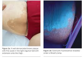 Image result for Erythrasma