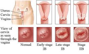 Sedangkan pada wanita, kemunculannya di vulva, vagina, pantat, atau paha atas. Cara Mengobati Penyakit Sipilis Pada Pria