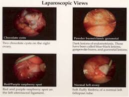 The added advantage of laparoscopy in endometriosis is that your diagnosis can be confirmed and if endometriosis can be seen during the laparoscopy, a sample will usually be taken for biopsy. Endometriosis