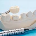 How Much Tooth is Needed for a Dental Crown?
