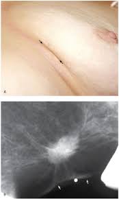 You notice dimply, scaly, patchy, or inflamed skin. Evaluation And Imaging Features Of Malignant Breast Masses Radiology Key