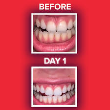 Maybe you would like to learn more about one of these? Zimba Whitening Strips 16 Led Accelerator Light Shopzimba Com
