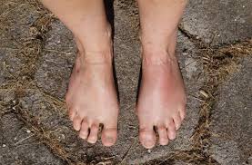 Image result for erysipel photos)