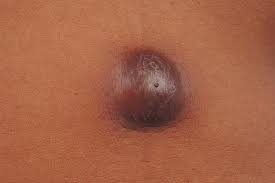 Image result for Cyst