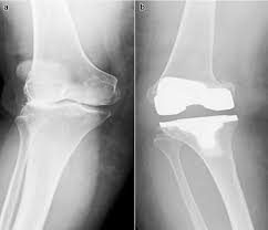 Suture fixation of a medial epicondyle fracture. Early Femoral Condyle Insufficiency Fractures After Total Knee Arthroplasty Treatment With Delayed Surgery And Femoral Component Revision Arthroplasty Today