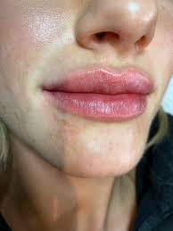 We wouldn't be caught dead wearing sheer panty hose, but when it comes to our lips? Lip Fillers Lip Augmentation Dermal Fillers Chin Fillers Tld