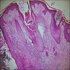 Marked pseudoepitheliomatous hyperplasia of the epidermis with hyperkeratosis and dense inflammatory cell. Multifocal Tuberculosis Verrucosa Cutis Scienceopen
