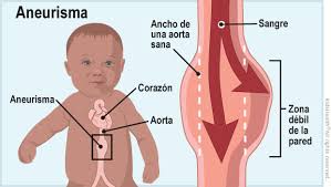 We did not find results for: Aneurismas Aorticos Para Padres Nemours Kidshealth