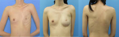 Poland syndrome is a birth defect characterized by an underdeveloped chest muscle and short webbed fingers on one side of the body. Breast Reconstruction In Poland Syndrome Patients With Latissimus Dorsi Myo Flap And Implant An Efficient Endoscopic Approach Using Single Transverse Axillary Incision Springerlink