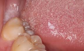 Image result for papillomavirus tongue)