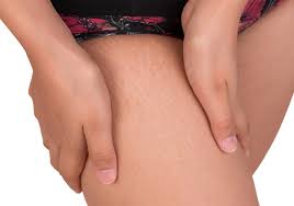 Stretch mark terjadi karena peregangan kulit berlebih. Cara Menghilangkan Stretch Mark Yang Efektif Alodokter