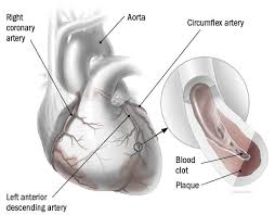 The two main branches are the left coronary artery (lca) and right coronary artery (rca). A Closer Look At Your Coronary Arteries Harvard Health