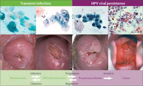 But the more sexual partners you have, the more likely they are to be exposed to hpv. Human Papillomavirus And Cervical Cancer The Lancet