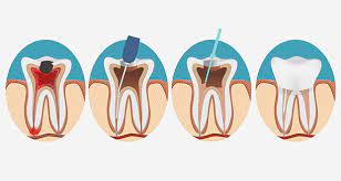 People who suffer from pain from a dental crown application or notice uncomfortable changes in their bite could need another appointment. Four Reasons For Abnormal Pain After Root Canal Surgery